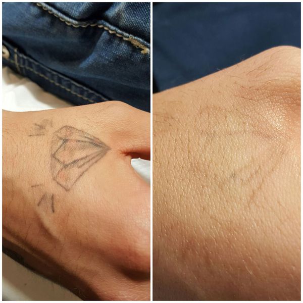 ᐅ Eliminación de tatuajes Antes y Después de una Sesión Láser