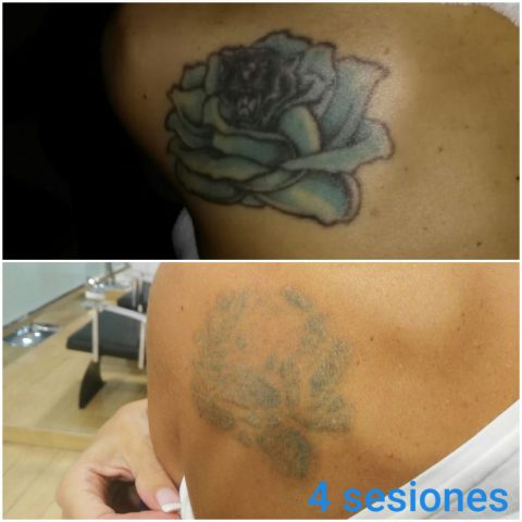 sesiones filanes eliminacion tatuajes espalda