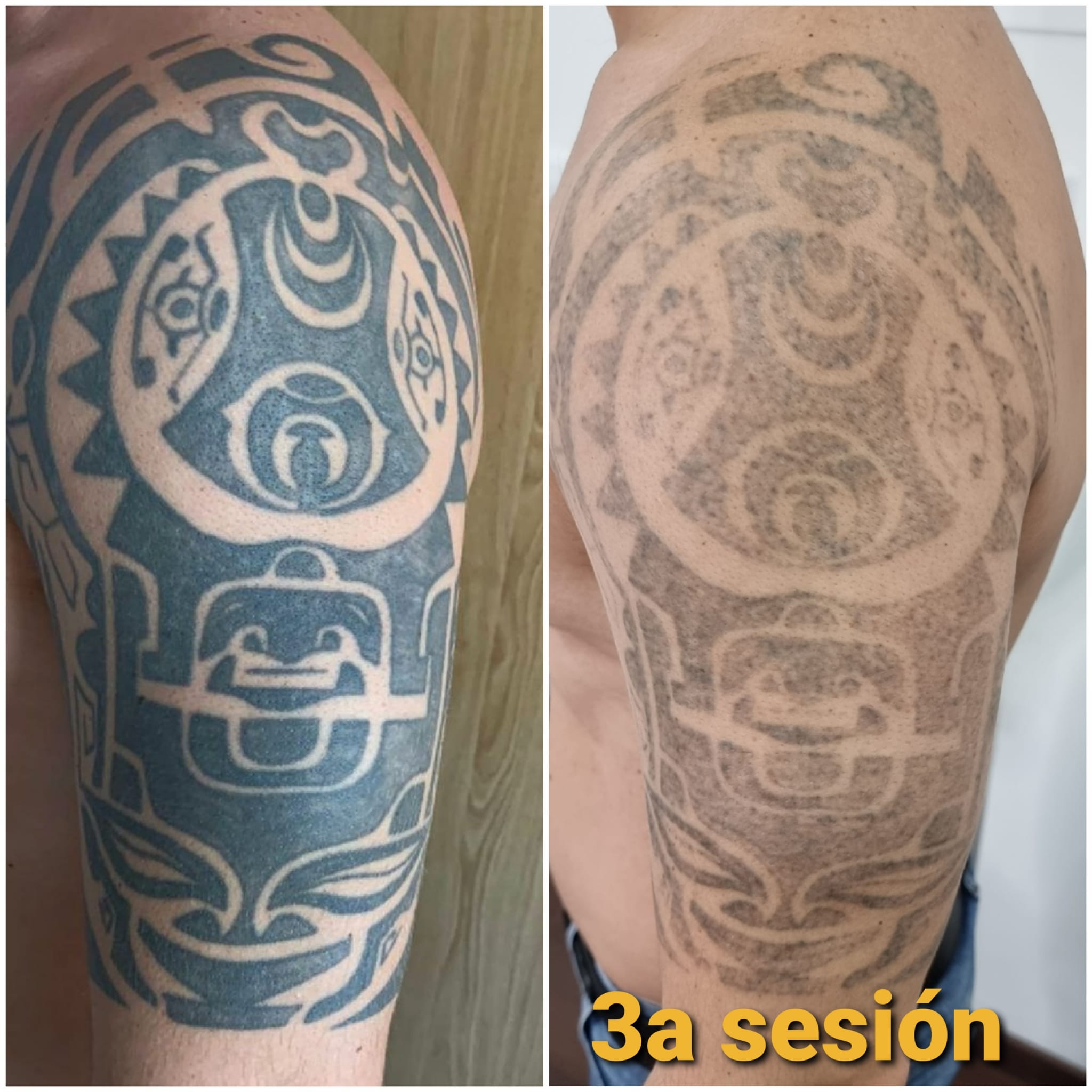 ᐅ Eliminación de tatuajes Antes y Después de una Sesión Láser