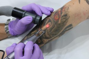 Eliminar tatuaje en una sesión